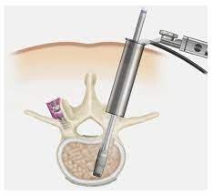 MINIMALLY INVASIVE TLIF