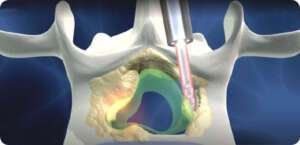 Minimally invasive spine surgery