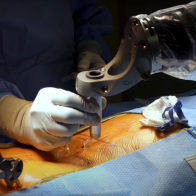 Robotics in Spine Surgery | Advanced Robotic Spine Surgery in Bareilly | Rohilkhand Medical College and Hospital